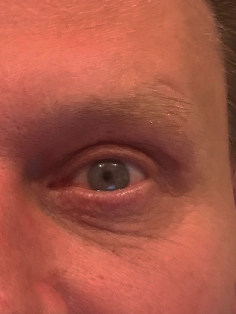Voor en na de ooglidcorrectie - Resultaten
